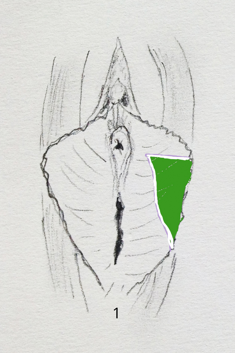 nymphoplastie triangulaire chirurgie de l'intimité annecy Genève