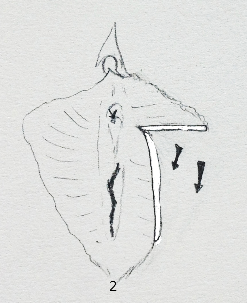 reconstruction des petites lèvres nymphoplastie Genève Annecy