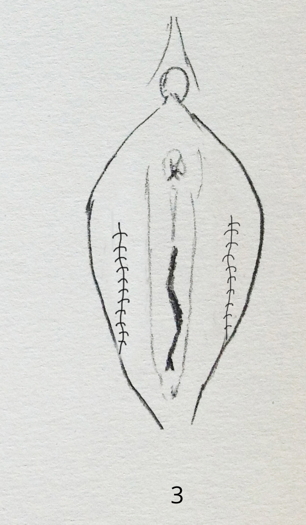 sutures fils résorbables chirurgie esthétique du sexe femme