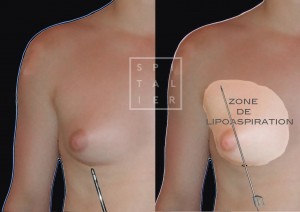 gynécomastie glande mammaire chez l'homme chirurgie par lipoaspiration