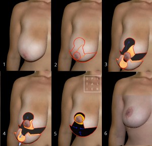 plastie mammaire pour hypertrophie chirurgien esthétique Annecy