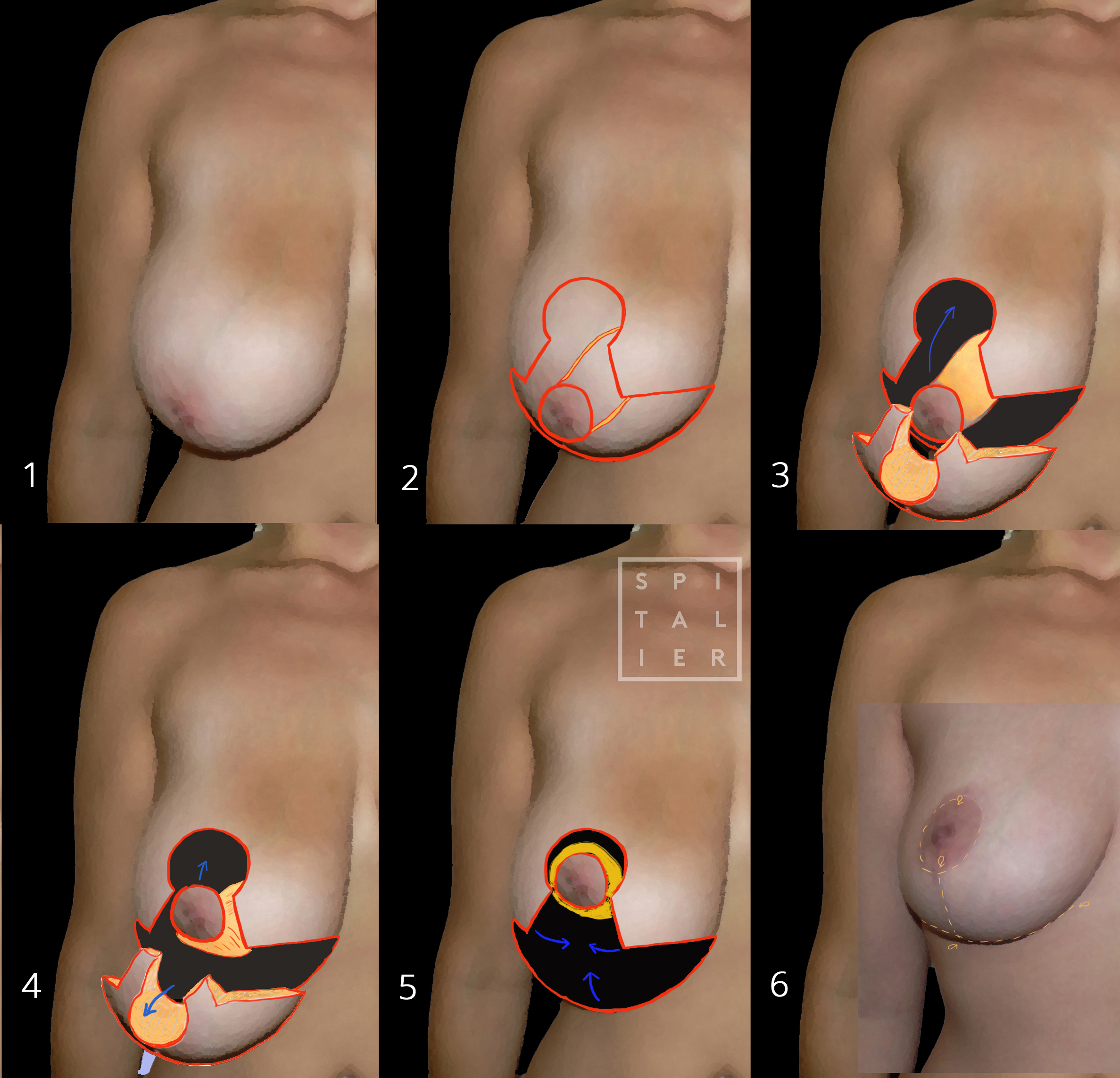 réduction mammaire hypertrophie Annecy