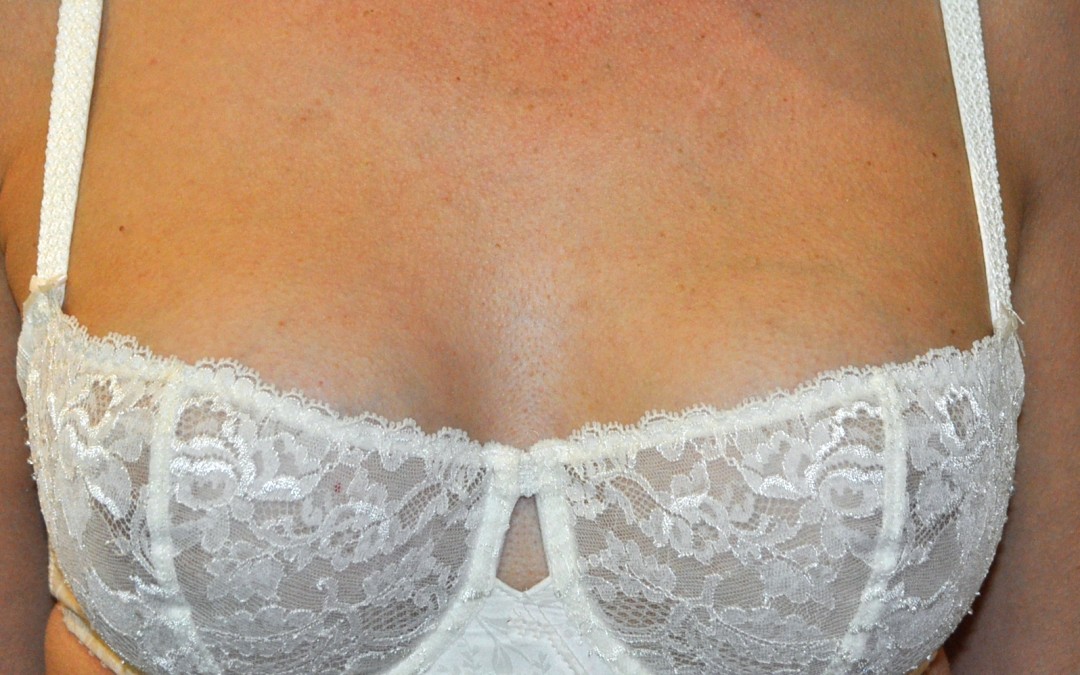 augmentation mammaire age chirurgie esthétique Annecy