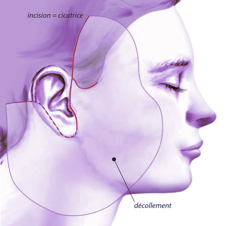 Où est l'incision d'un lifting cervico facial lifting décollement incision