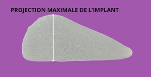 prothèse implant anatomique esthetique haute savoie