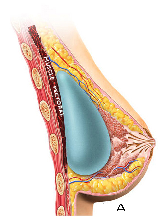 prothes implant mammaire prépectoral