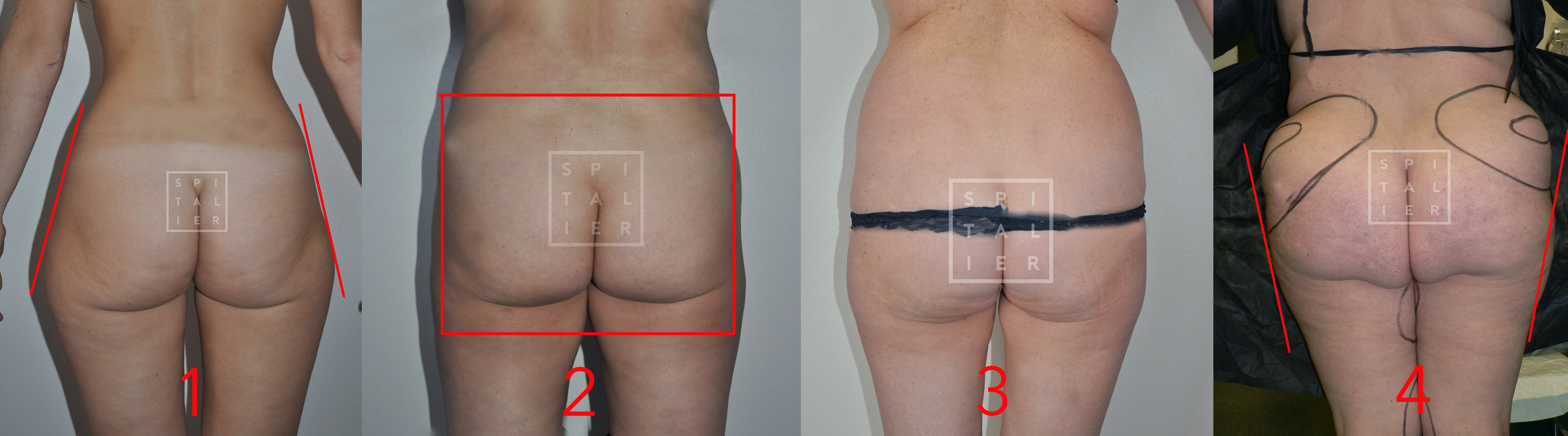 Fesses en A, en carré,en O,en V classification des fesses spitalier annecy genève
