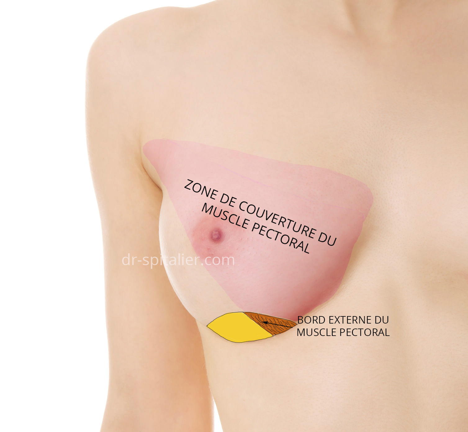 l'incision expose le muscle pectoral augmentation mammaire dual plan annecy genève