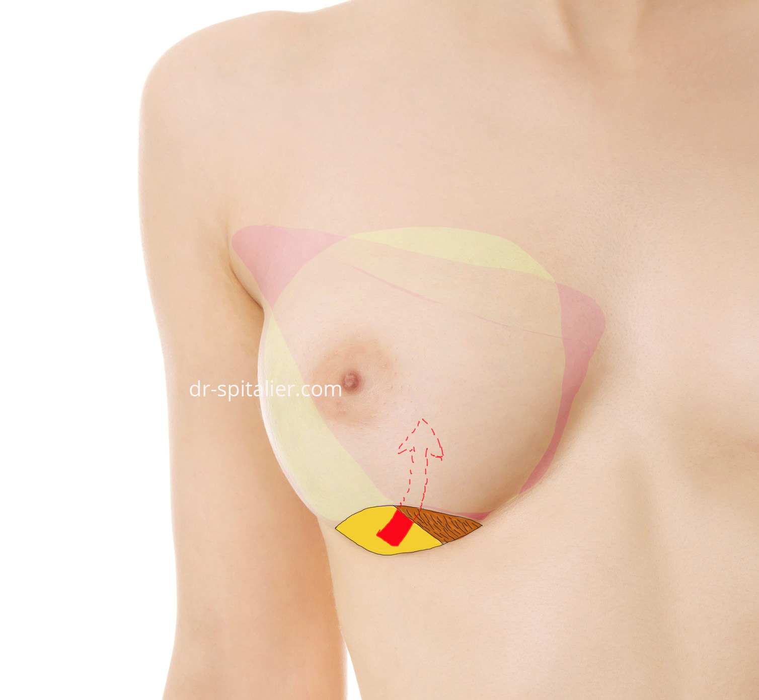 augmentation mammaire prothèses loge rétropectorale
