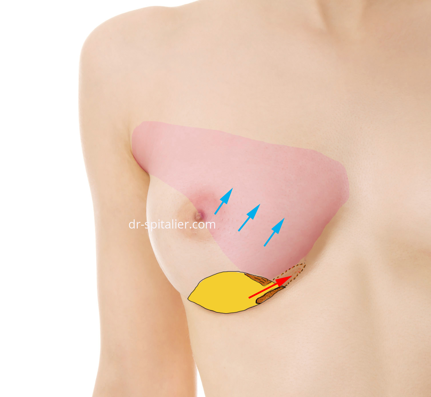 le muscle pectoral est sectionné au niveau de ses insertions inféro internes augmentation mammaire annecy dual plan
