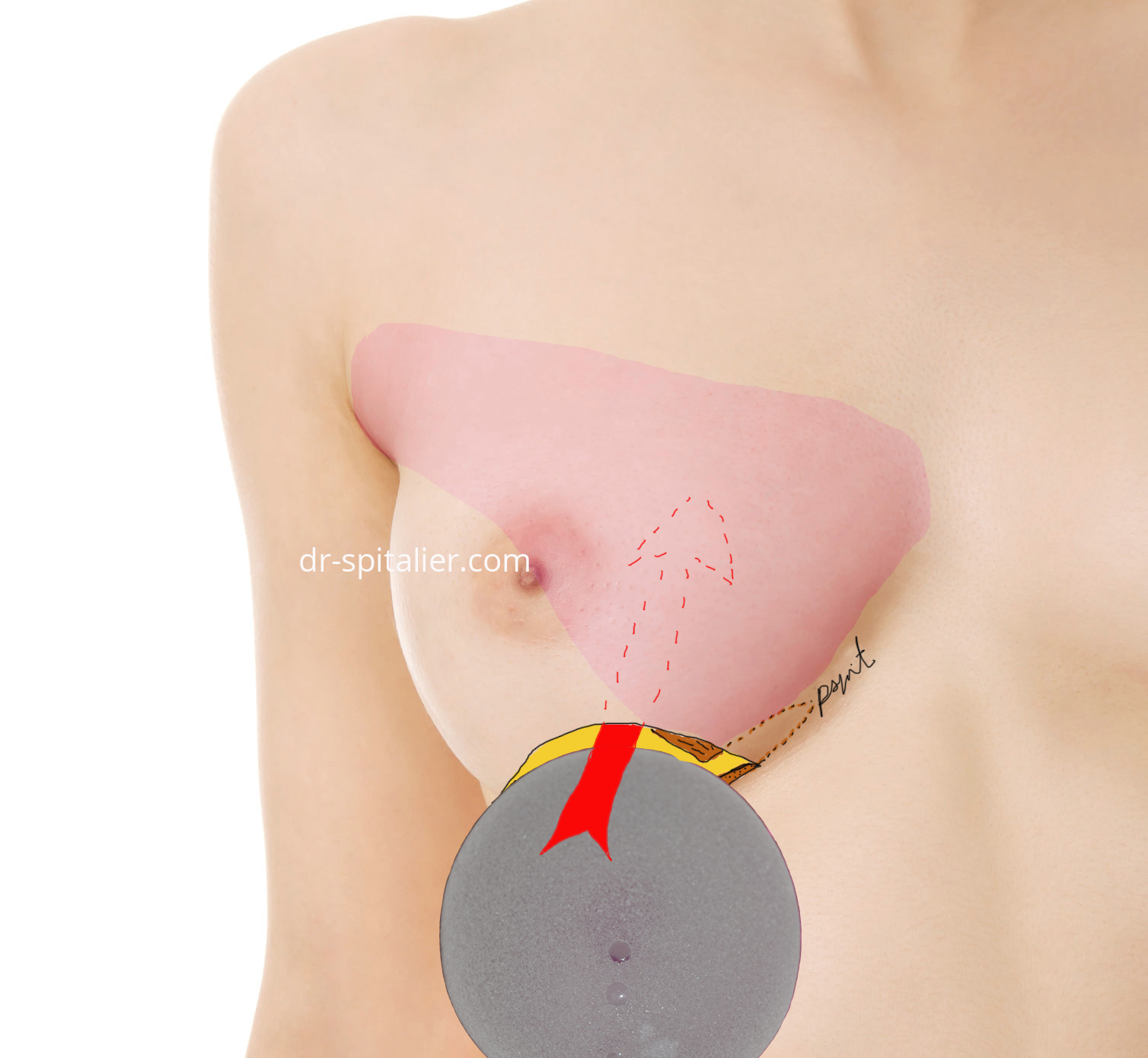 l'implant est glissé facilement sous le muscle pectoral prothéses mammaires annecy genève