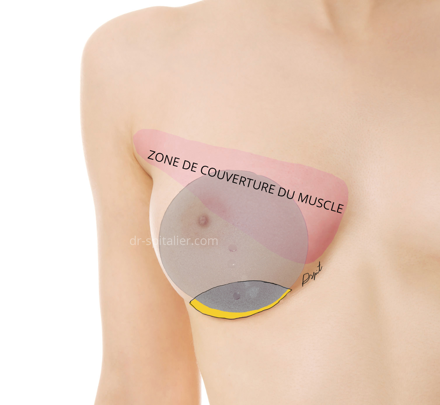 l'implant est sous le muscle en haut et derrière la glande en bas dual plan augmentation mammaire implant