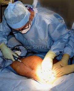 lipofilling mammaire graisse sein augmentation mammaire