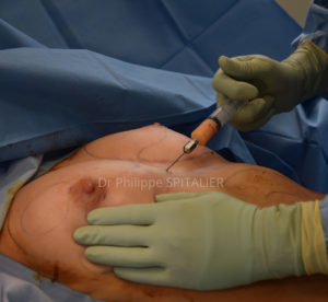 lipofilling mammaire lipofilling annecy augmentation