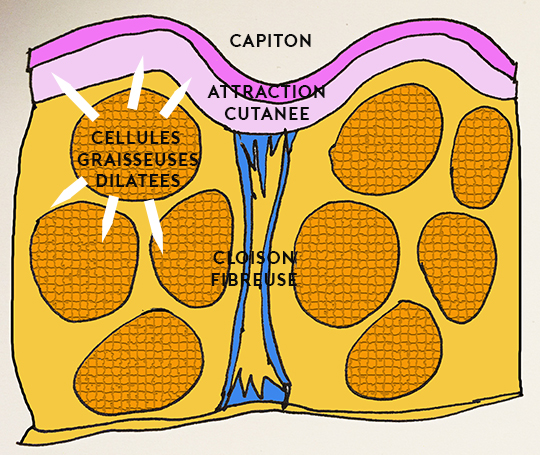 qwo cellulite fesses