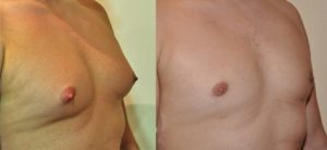 gynecomastie annecy haute savoie avant après