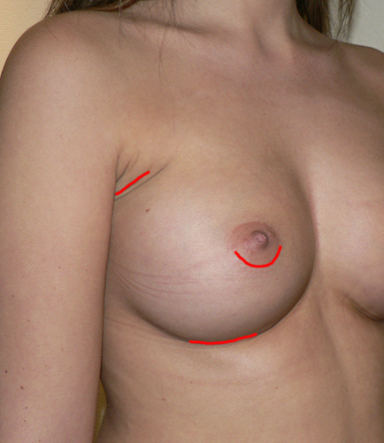 augmentation mammaire cicatrice annecy