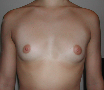 hypomastie implants mammaires annecy